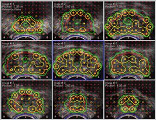 Radiation treatment plan for permanent prostate seed brachytherapy