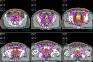 Photo: A radiation treatment plan for prostate IMRT.