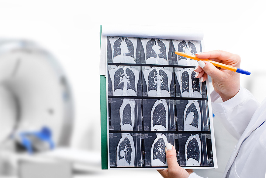 Lung cancer xray